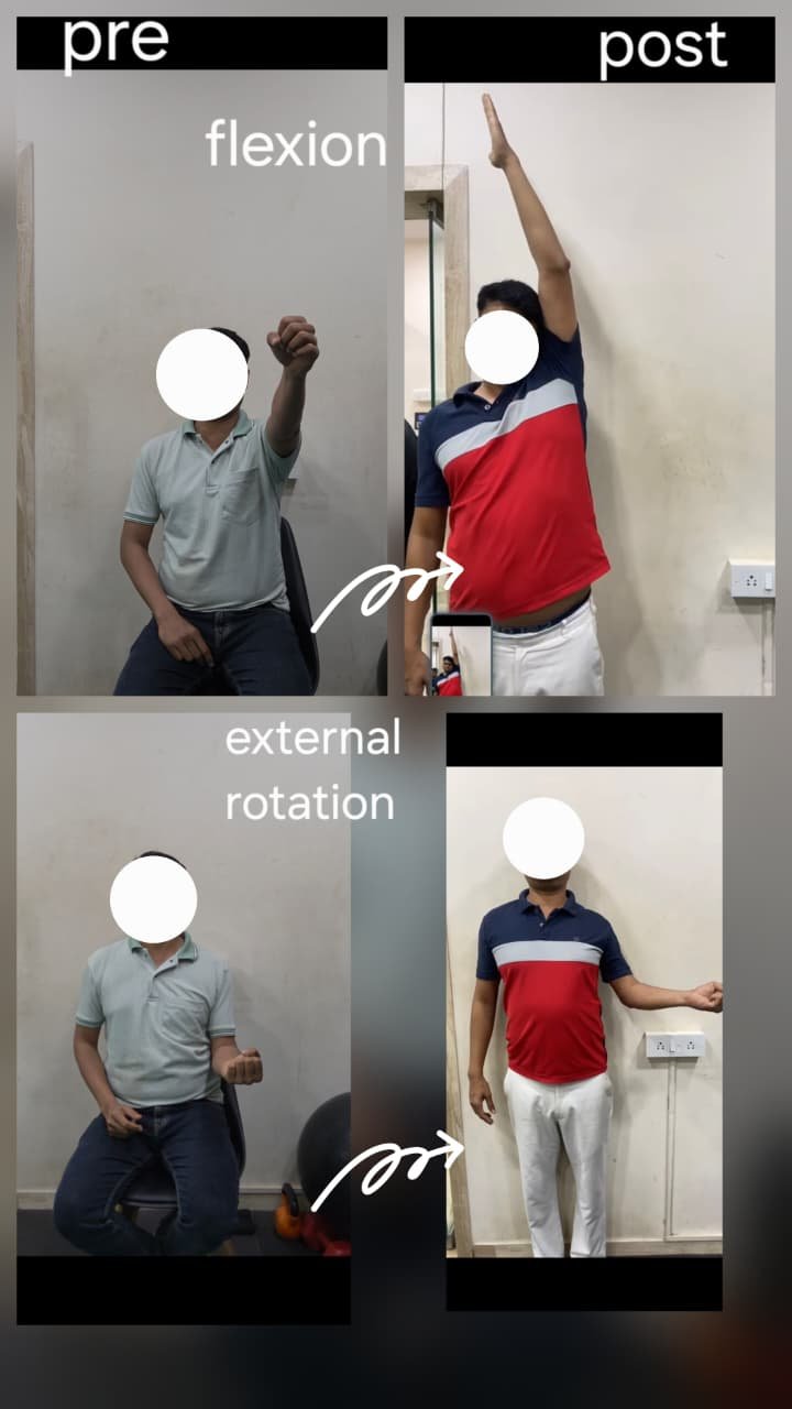 Bankart Lesion shoulder rehabilitation before and after — pre and post treatment results by Dr. Pushpa Sharma at Physioridham, Girgaon, Mumbai